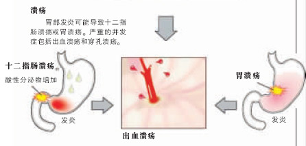 幽门螺杆菌引发胃溃疡过程示意图:溃疡